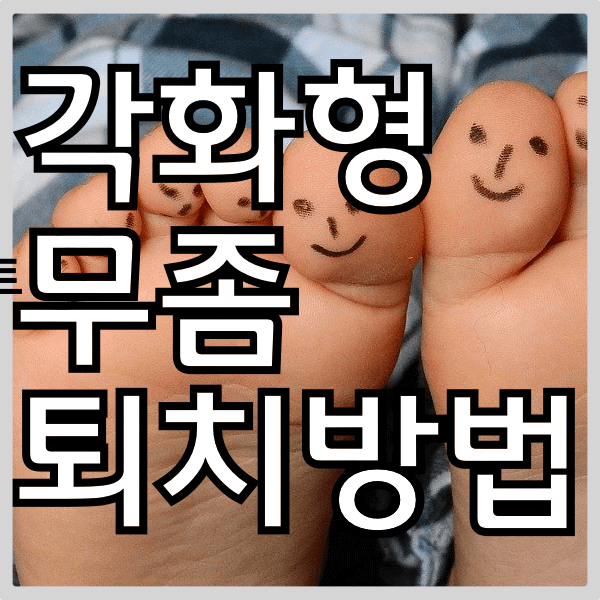 각화형 무좀의 종류와 개선방법 쉽게