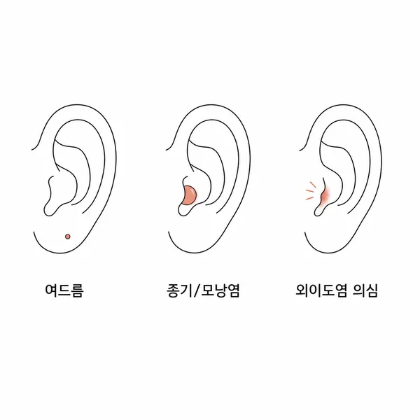 귀 여드름, 종기와 모낭염, 외이도염 의심 증상을 비교한 그림