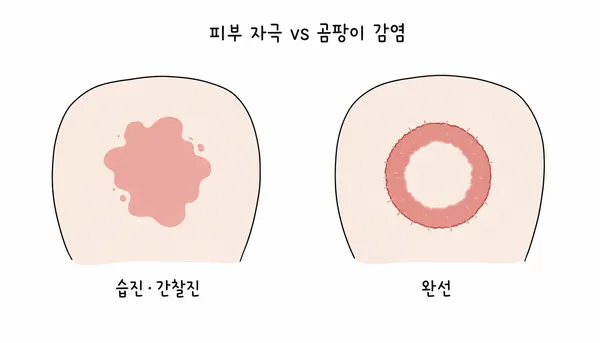 사타구니 습진과 완선의 발진 모양 차이를 단순하게 비교한 그림