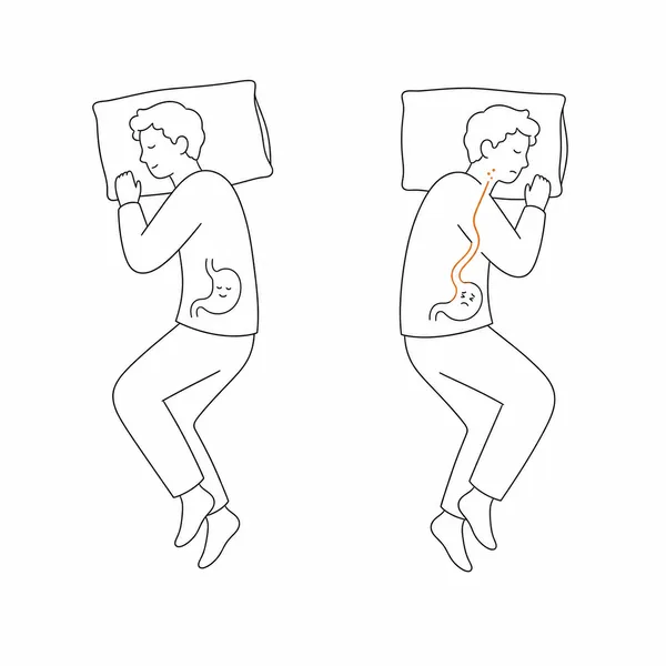 왼쪽 수면과 오른쪽 수면에서 위산 역류 차이를 보여주는 선 그림