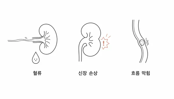 급성신부전의 세 가지 원인인 혈류 감소, 콩팥 자체 손상, 소변길 폐쇄를 보여주는 단순 일러스트