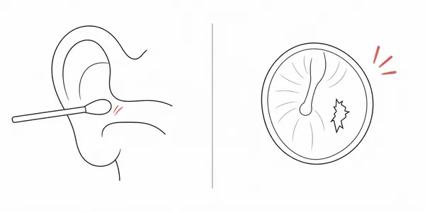 면봉으로 생긴 외이도 상처와 고막 문제를 비교한 단순 의학 일러스트
